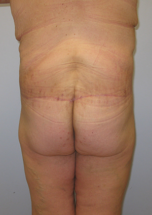 Buttock Lift Before & After Image