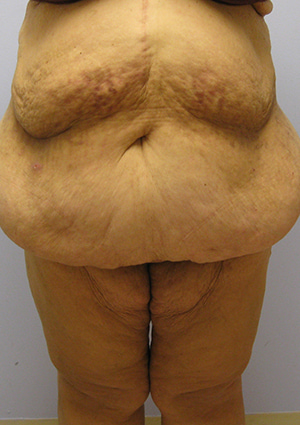 Buttock Lift Before & After Image