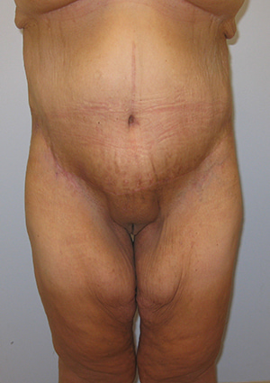 Buttock Lift Before & After Image