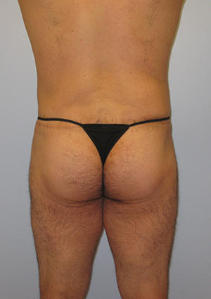 Buttock Lift Before & After Image