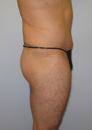 Buttock Lift Before & After Image