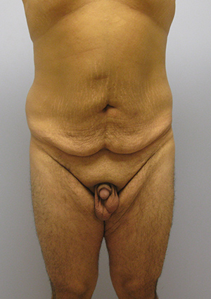 Buttock Lift Before & After Image