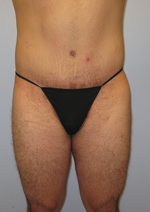 Buttock Lift Before & After Image