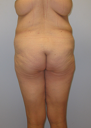 Buttock Lift Before & After Image