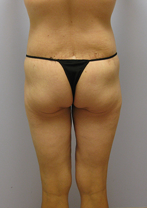 Buttock Lift Before & After Image