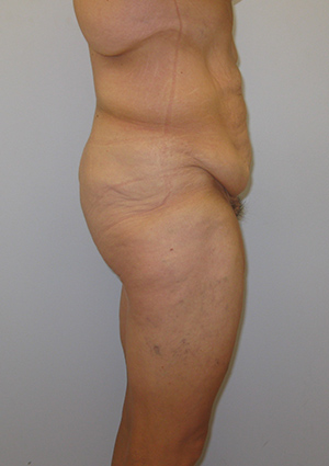 Buttock Lift Before & After Image