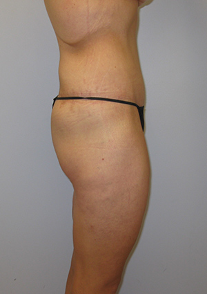 Buttock Lift Before & After Image