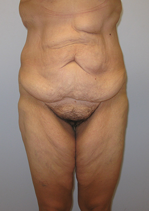 Buttock Lift Before & After Image