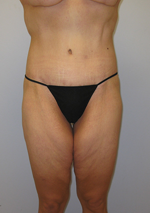 Buttock Lift Before & After Image