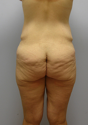 Buttock Lift Before & After Image