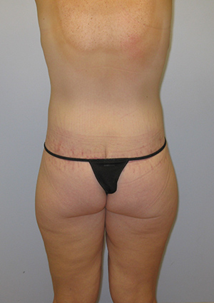 Buttock Lift Before & After Image