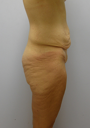 Buttock Lift Before & After Image