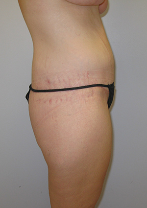 Buttock Lift Before & After Image