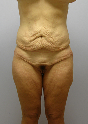 Buttock Lift Before & After Image