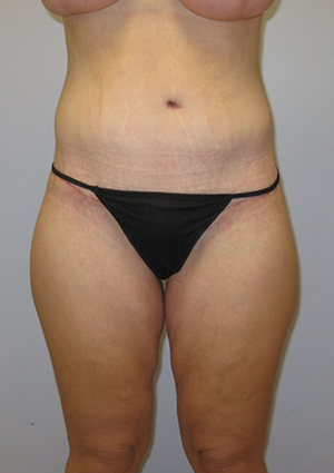 Buttock Lift Before & After Image