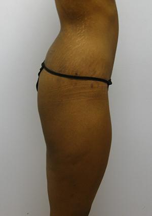 Buttock Lift Before & After Image