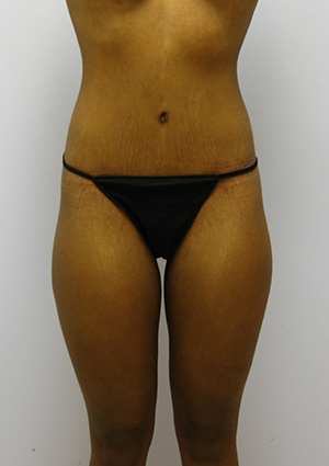 Buttock Lift Before & After Image