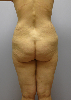 Buttock Lift Before & After Image