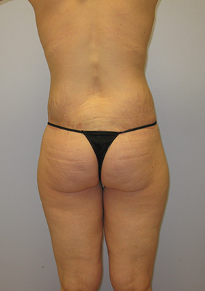 Buttock Lift Before & After Image