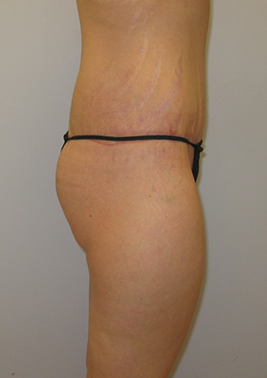 Buttock Lift Before & After Image