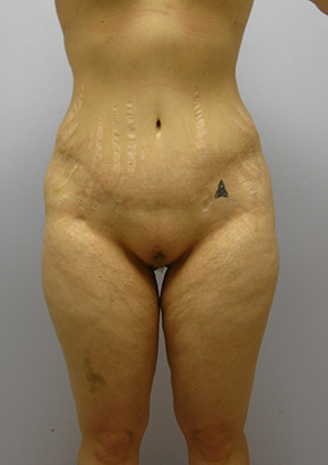 Buttock Lift Before & After Image