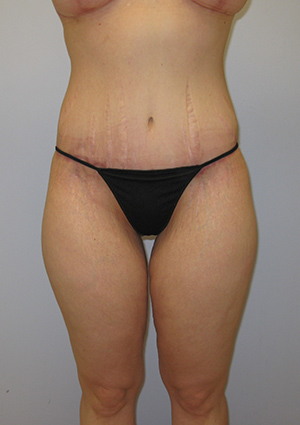 Buttock Lift Before & After Image