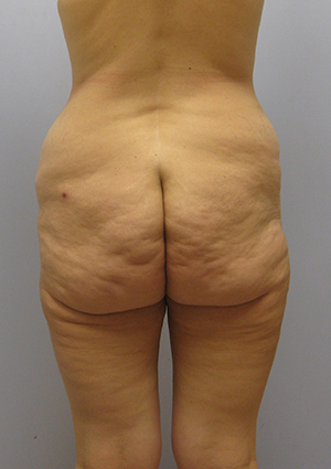 Buttock Lift Before & After Image