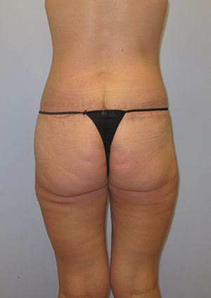 Buttock Lift Before & After Image