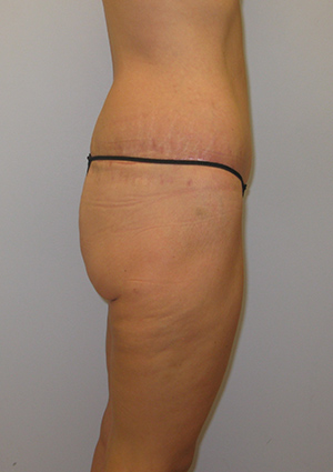 Buttock Lift Before & After Image