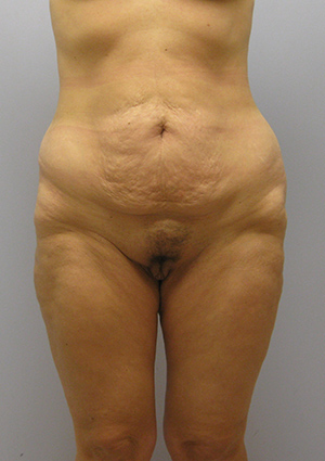 Buttock Lift Before & After Image