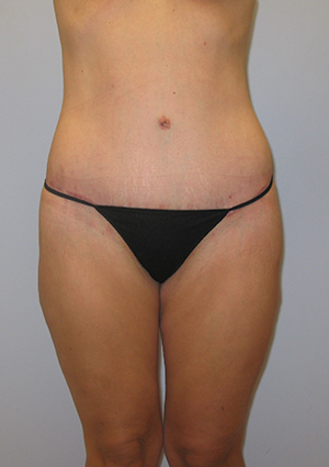 Buttock Lift Before & After Image