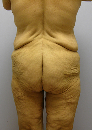 Buttock Lift Before & After Image