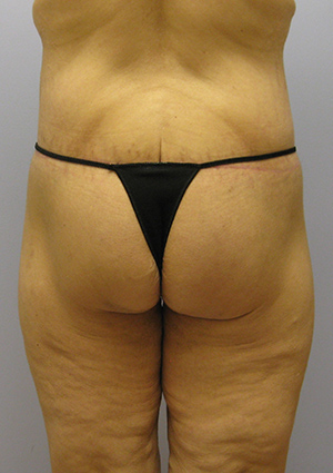 Buttock Lift Before & After Image