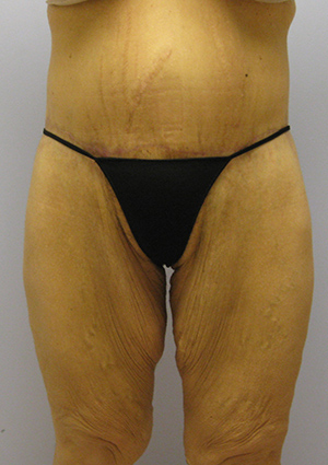 Buttock Lift Before & After Image