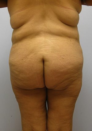 Buttock Lift Before & After Image