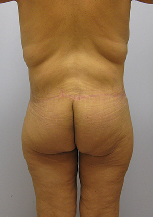 Buttock Lift Before & After Image