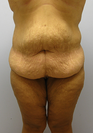 Buttock Lift Before & After Image