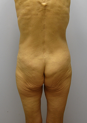 Buttock Lift Before & After Image