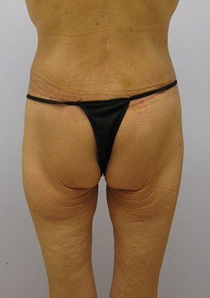 Buttock Lift Before & After Image