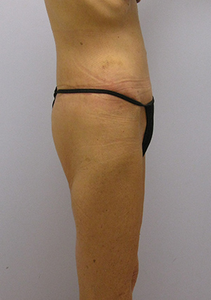 Buttock Lift Before & After Image