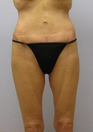 Buttock Lift Before & After Image