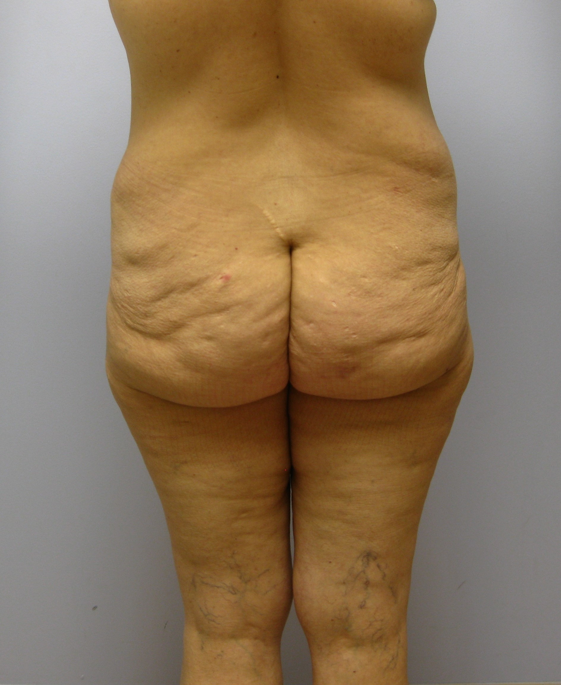 Buttock Lift Before & After Image