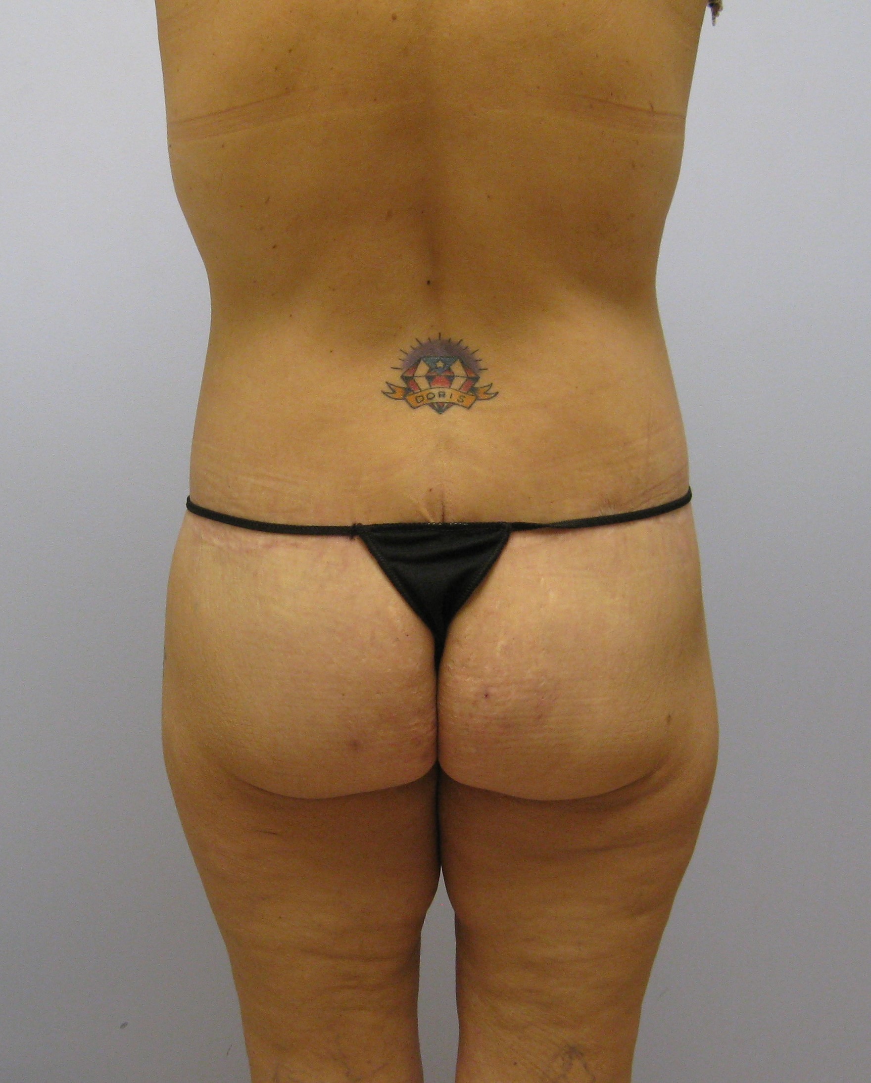 Buttock Lift Before & After Image