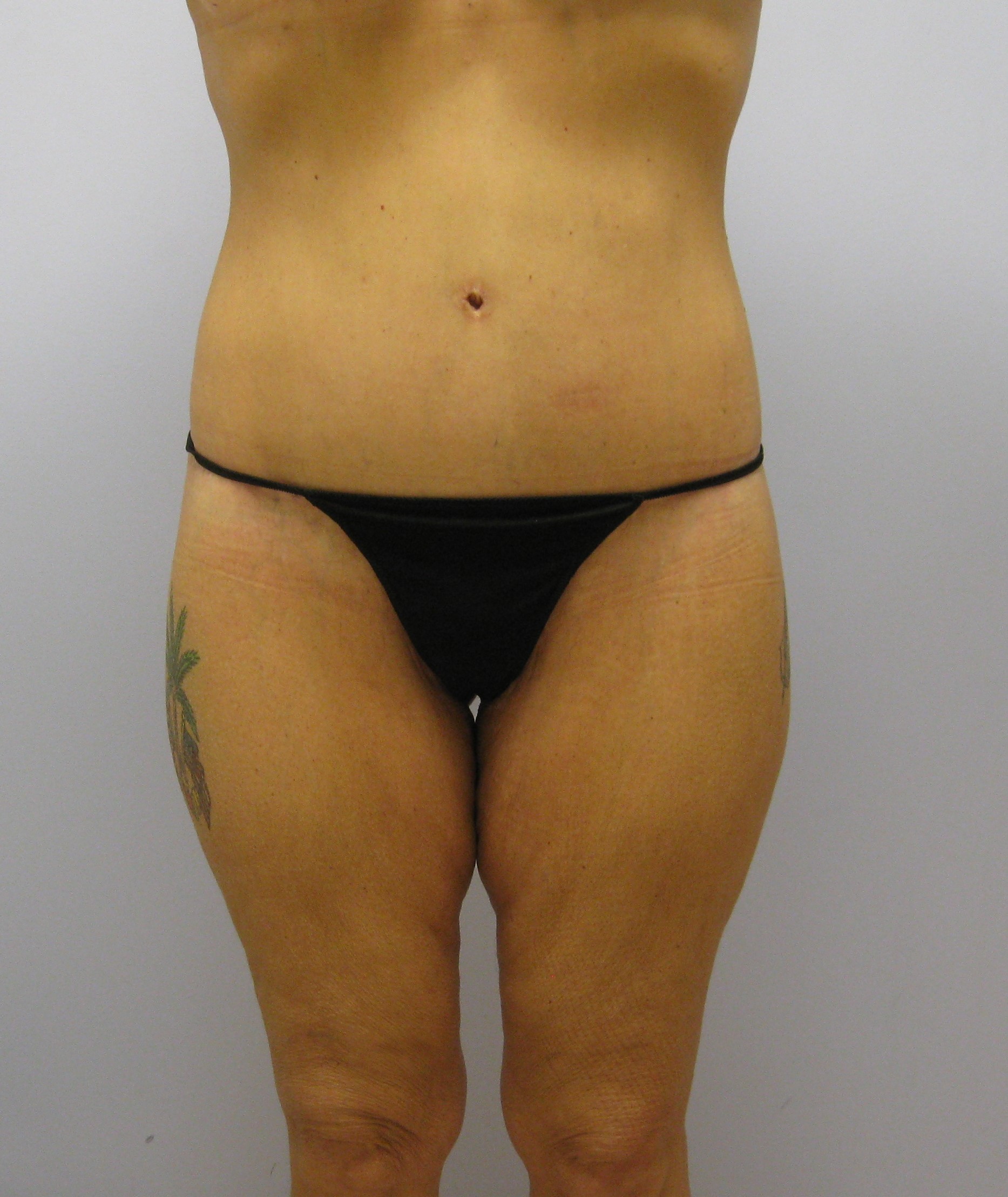 Buttock Lift Before & After Image