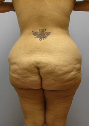 Buttock Lift Before & After Image