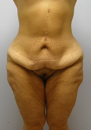 Buttock Lift Before & After Image