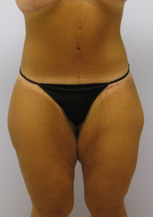 Buttock Lift Before & After Image