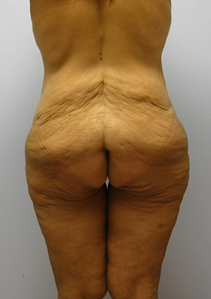 Buttock Lift Before & After Image