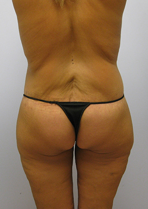 Buttock Lift Before & After Image