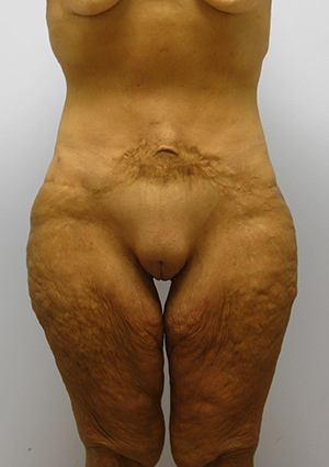 Buttock Lift Before & After Image